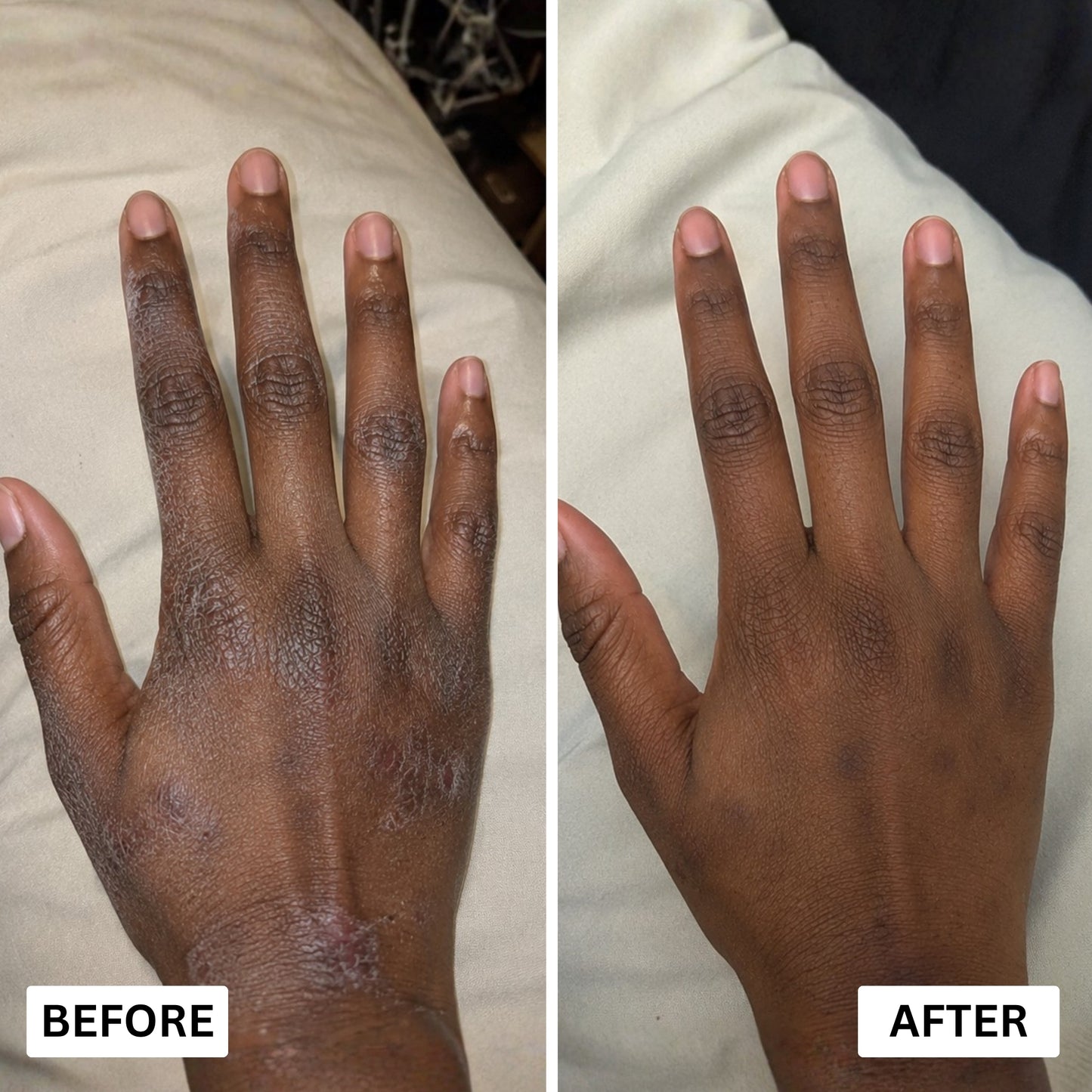 Orevela® Wild Oregano & Black Seed Oil - Calms Eczema From The Inside, Not The Surface