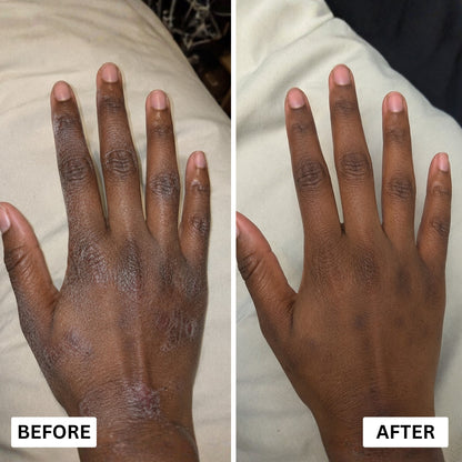 Orevela® Wild Oregano & Black Seed Oil - Calms Eczema From The Inside, Not The Surface