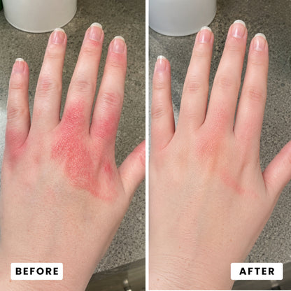 Orevela® Wild Oregano & Black Seed Oil - Calms Eczema From The Inside, Not The Surface