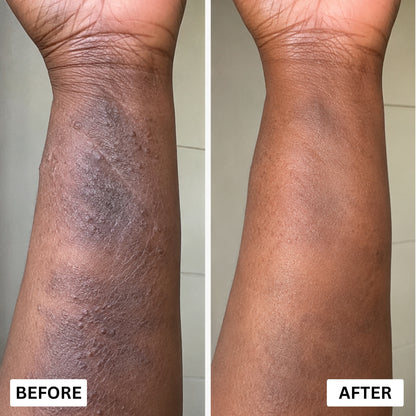 Orevela® Wild Oregano & Black Seed Oil - Calms Eczema From The Inside, Not The Surface