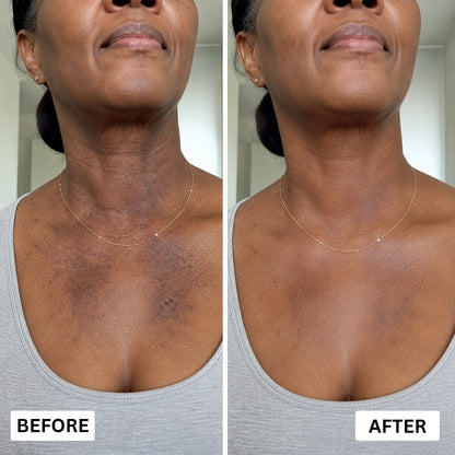 Orevela® Wild Oregano & Black Seed Oil - Calms Eczema From The Inside, Not The Surface
