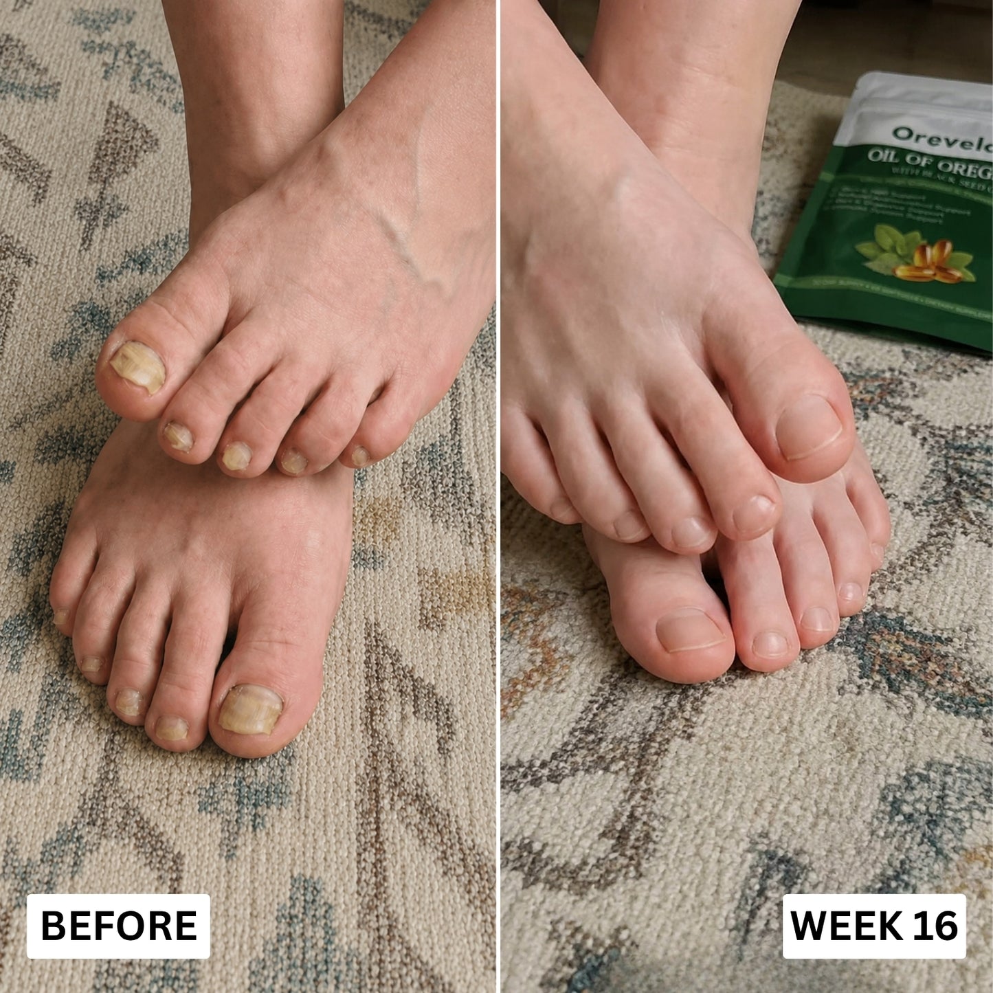 Orevela® Wild Oregano & Black Seed Oil - Calms Eczema From The Inside, Not The Surface